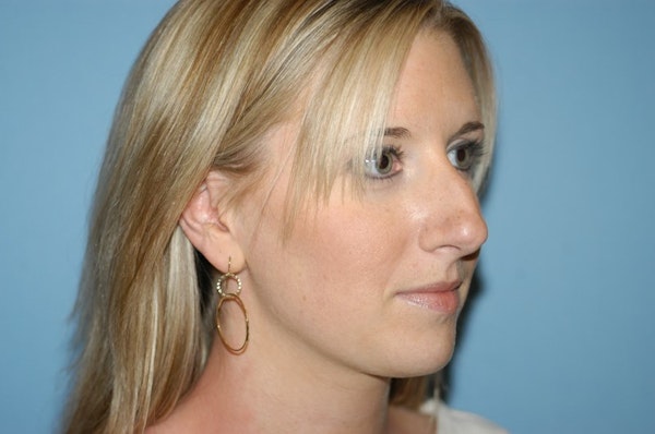 Rhinoplasty Before & After Gallery - Patient 143501 - Image 5