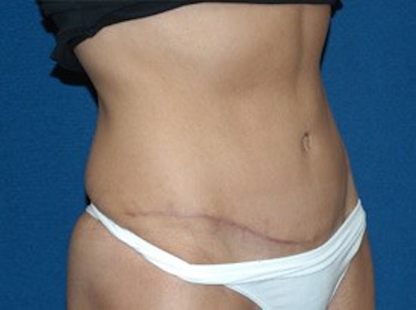 Tummy Tuck Before & After Gallery - Patient 382043 - Image 4