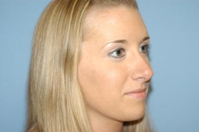 Rhinoplasty Before & After Gallery - Patient 143501 - Image 6