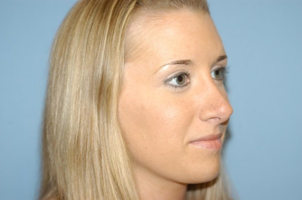 Rhinoplasty Before & After Gallery - Patient 143501 - Image 6