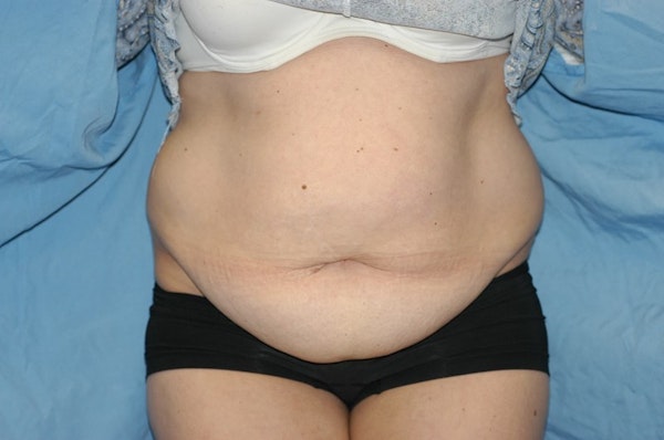 Tummy Tuck Before & After Gallery - Patient 115659 - Image 1