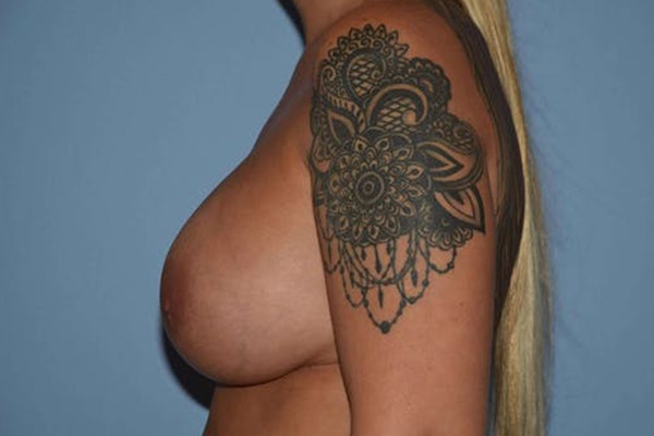 Breast Revision Before & After Gallery - Patient 118886 - Image 6
