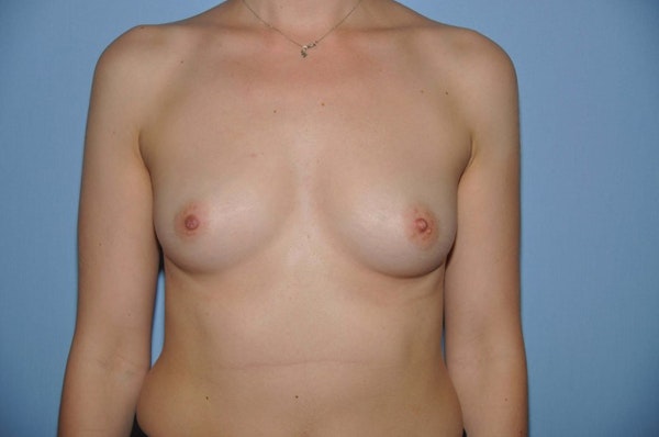 Breast Augmentation Before & After Gallery - Patient 262251 - Image 1