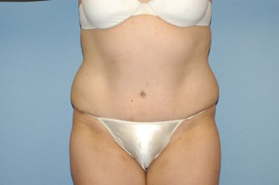 Tummy Tuck Before & After Gallery - Patient 115659 - Image 2