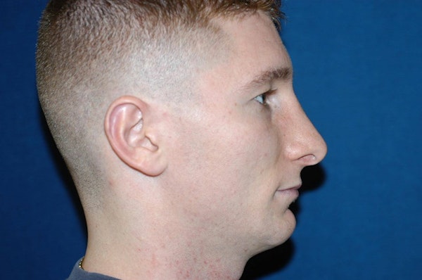 Rhinoplasty Before & After Gallery - Patient 760987 - Image 2