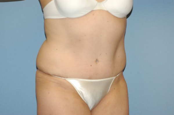 Tummy Tuck Before & After Gallery - Patient 115659 - Image 4