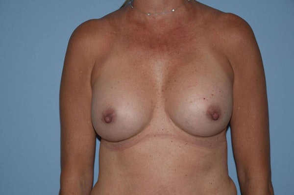 Breast Revision Before & After Gallery - Patient 228654 - Image 2