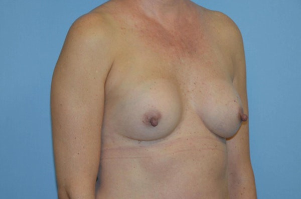 Breast Revision Before & After Gallery - Patient 228654 - Image 3