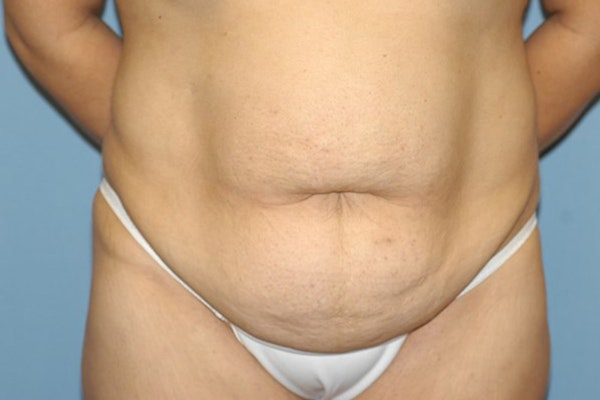 Tummy Tuck Before & After Gallery - Patient 261590 - Image 1