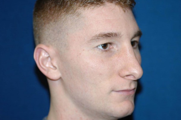 Rhinoplasty Before & After Gallery - Patient 760987 - Image 6