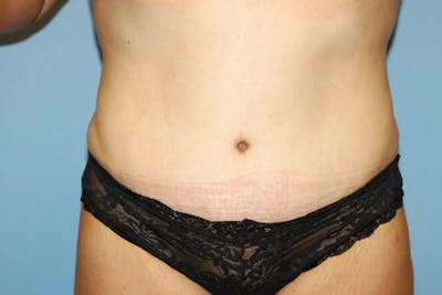 Tummy Tuck Before & After Gallery - Patient 261590 - Image 2