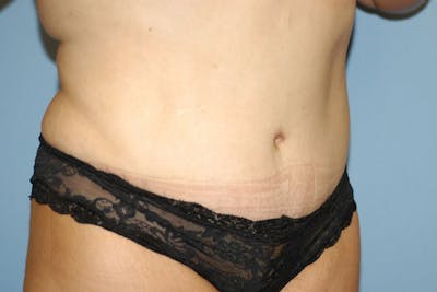 Tummy Tuck Before & After Gallery - Patient 261590 - Image 4