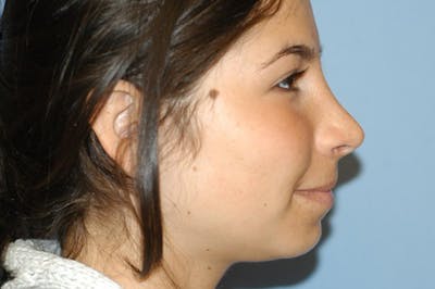 Rhinoplasty Before & After Gallery - Patient 166105 - Image 2