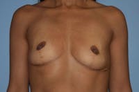 Breast Revision Before & After Gallery - Patient 244069 - Image 1