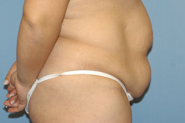 Tummy Tuck Before & After Gallery - Patient 261590 - Image 5