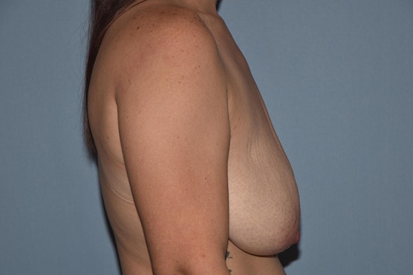 Breast Lift Before & After Gallery - Patient 326647 - Image 3