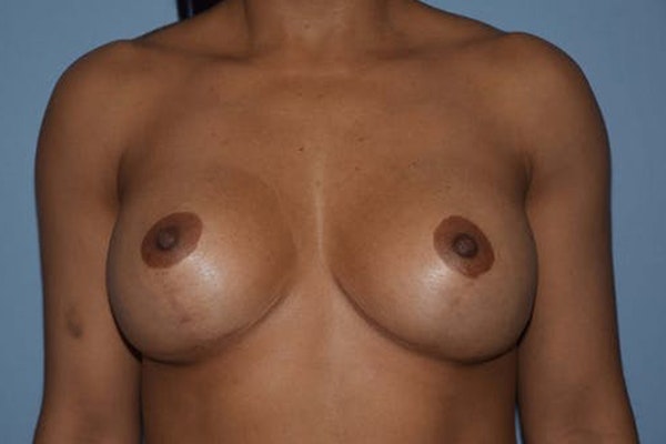 Breast Revision Before & After Gallery - Patient 244069 - Image 2