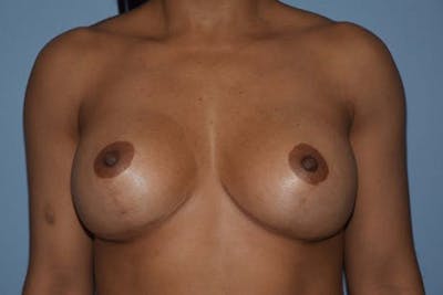 Breast Revision Before & After Gallery - Patient 244069 - Image 2