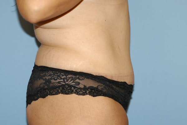 Tummy Tuck Before & After Gallery - Patient 261590 - Image 6