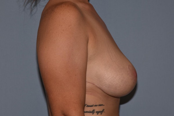 Breast Lift Before & After Gallery - Patient 326647 - Image 4