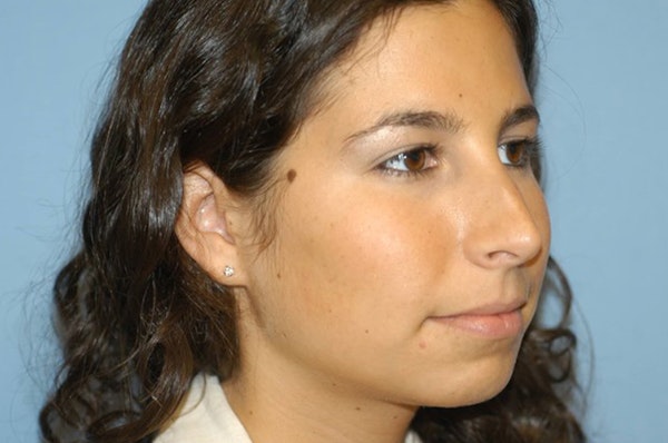 Rhinoplasty Before & After Gallery - Patient 166105 - Image 5