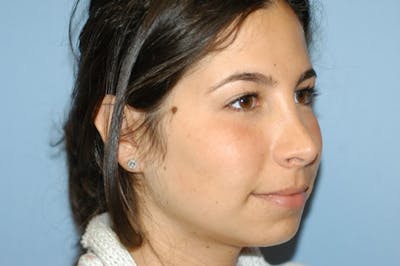 Rhinoplasty Before & After Gallery - Patient 166105 - Image 6