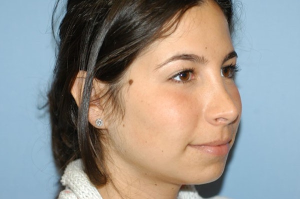 Rhinoplasty Before & After Gallery - Patient 166105 - Image 6
