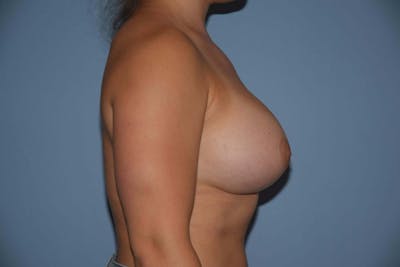 Breast Augmentation Before & After Gallery - Patient 112355 - Image 6