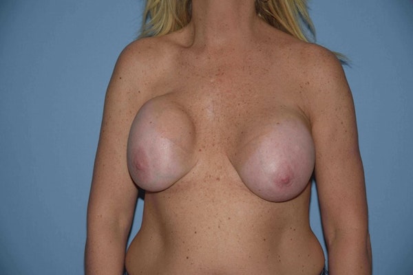 Breast Revision Before & After Gallery - Patient 373951 - Image 1