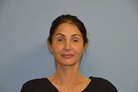Facelift Before & After Gallery - Patient 658826 - Image 1