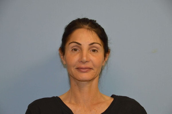 Facelift Before & After Gallery - Patient 658826 - Image 1