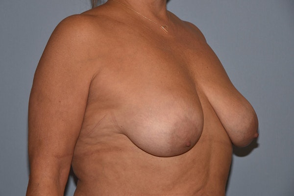 Breast Lift Before & After Gallery - Patient 422588 - Image 3