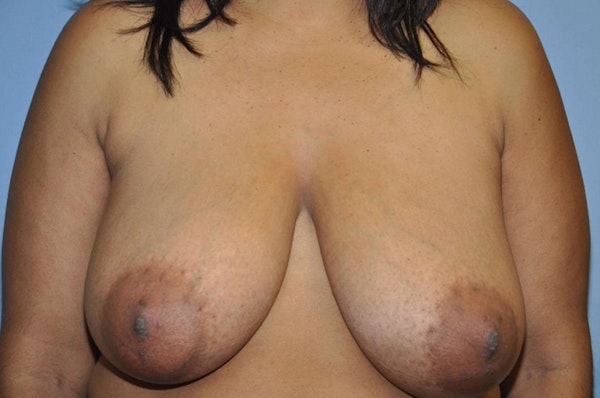 Breast Reduction Before & After Gallery - Patient 385702 - Image 1