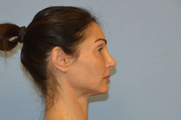 Facelift Before & After Gallery - Patient 658826 - Image 5
