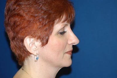 Rhinoplasty Before & After Gallery - Patient 422439 - Image 2