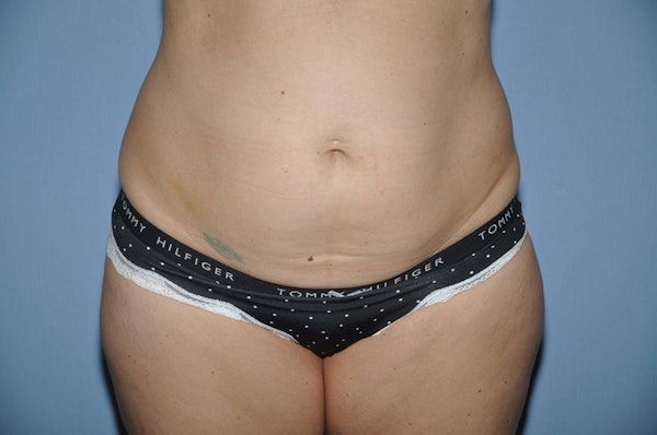 Tummy Tuck Before & After Gallery - Patient 253225 - Image 1