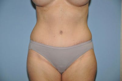 Tummy Tuck Before & After Gallery - Patient 253225 - Image 2
