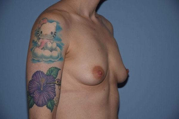 Breast Augmentation Before & After Gallery - Patient 538492 - Image 3