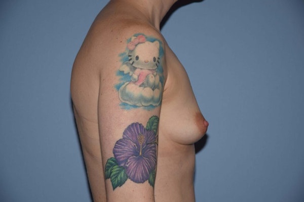Breast Augmentation Before & After Gallery - Patient 538492 - Image 5