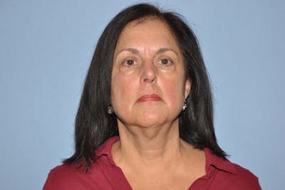 Facelift Before & After Gallery - Patient 210855 - Image 1