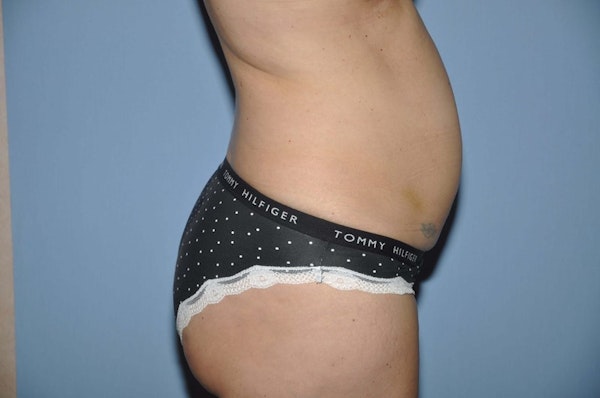 Tummy Tuck Before & After Gallery - Patient 253225 - Image 5