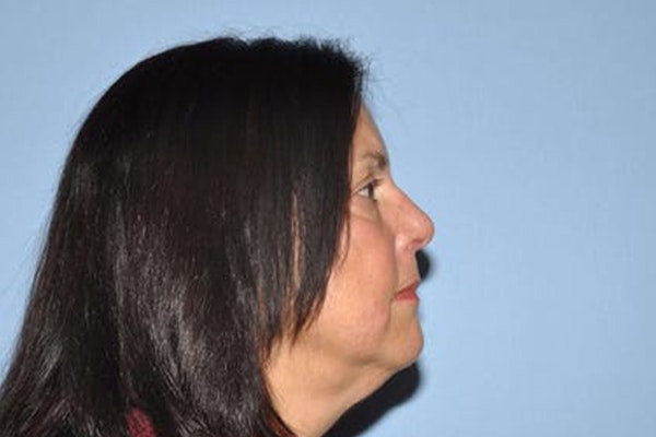 Facelift Before & After Gallery - Patient 210855 - Image 3