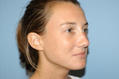 Rhinoplasty Before & After Gallery - Patient 260497 - Image 6