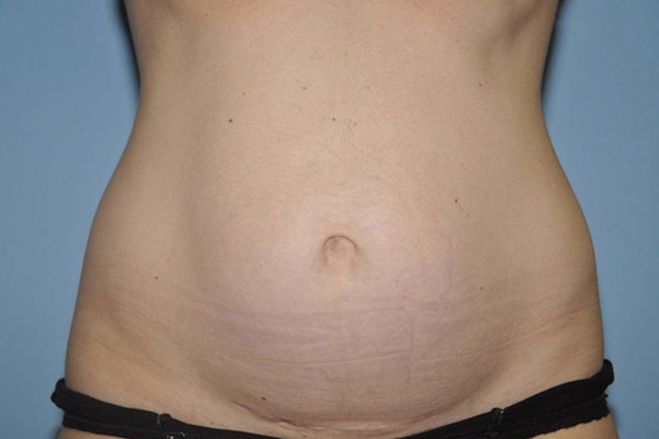 Tummy Tuck Before & After Gallery - Patient 153299 - Image 1
