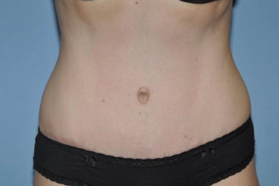 Tummy Tuck Before & After Gallery - Patient 153299 - Image 2
