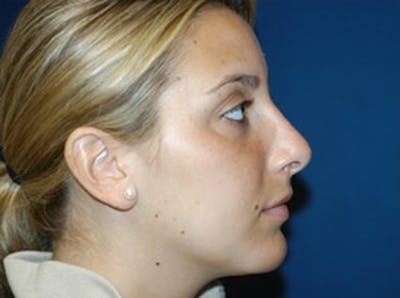 Rhinoplasty Before & After Gallery - Patient 850181 - Image 2