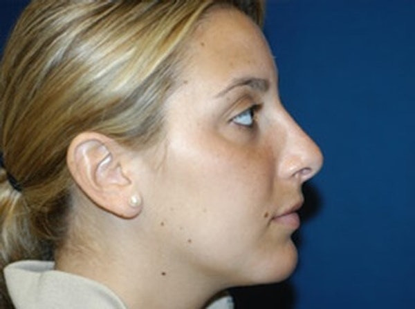 Rhinoplasty Before & After Gallery - Patient 850181 - Image 2