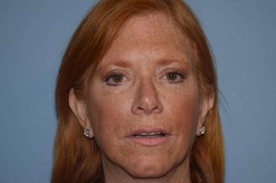 Facelift Before & After Gallery - Patient 300636 - Image 2