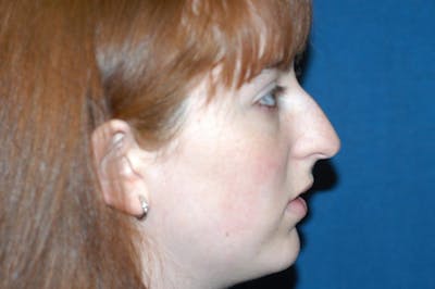 Rhinoplasty Before & After Gallery - Patient 126925 - Image 1