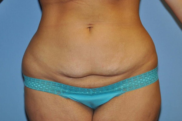 Tummy Tuck Before & After Gallery - Patient 119198 - Image 1